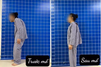 Bệnh nhân đã được can thiệp chỉnh gù cột sống thành công. 
