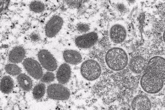 Hình ảnh dưới kính hiển vi cho thấy virus đậu mùa khỉ trong mẫu bệnh phẩm của một bệnh nhân. (Ảnh: Reuters/TTXVN)