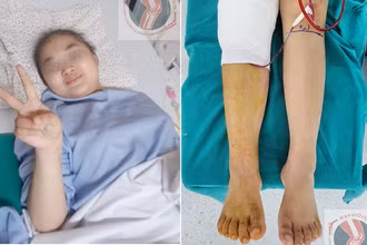 Bệnh nhi đang dần bình phục sức khỏe với đôi bàn chân mới. 