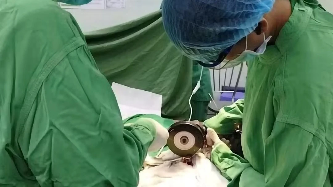 Phẫu thuật cứu bệnh nhân bị dị vật kim loại dạng đai ốc siết chặt dương vật