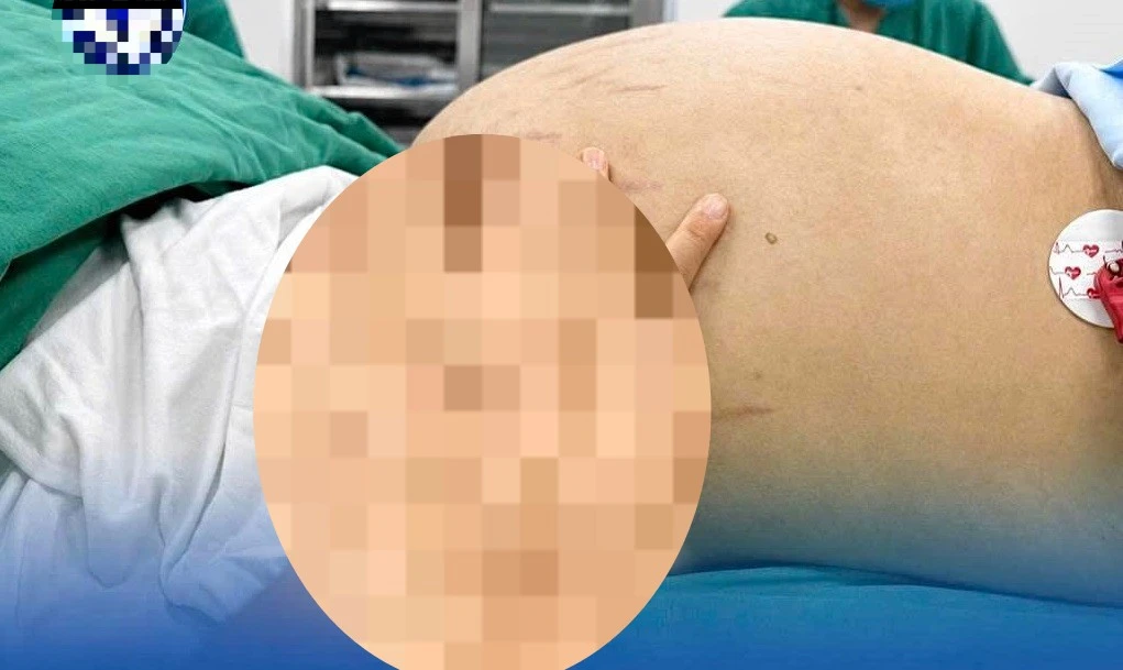 Tưởng béo bụng, hóa ra mang khối u buồng trứng khổng lồ to 30cm