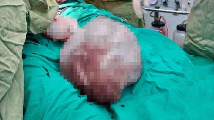 Bé gái 14 tuổi mang khối u nặng hơn 4kg có răng, tóc, xương