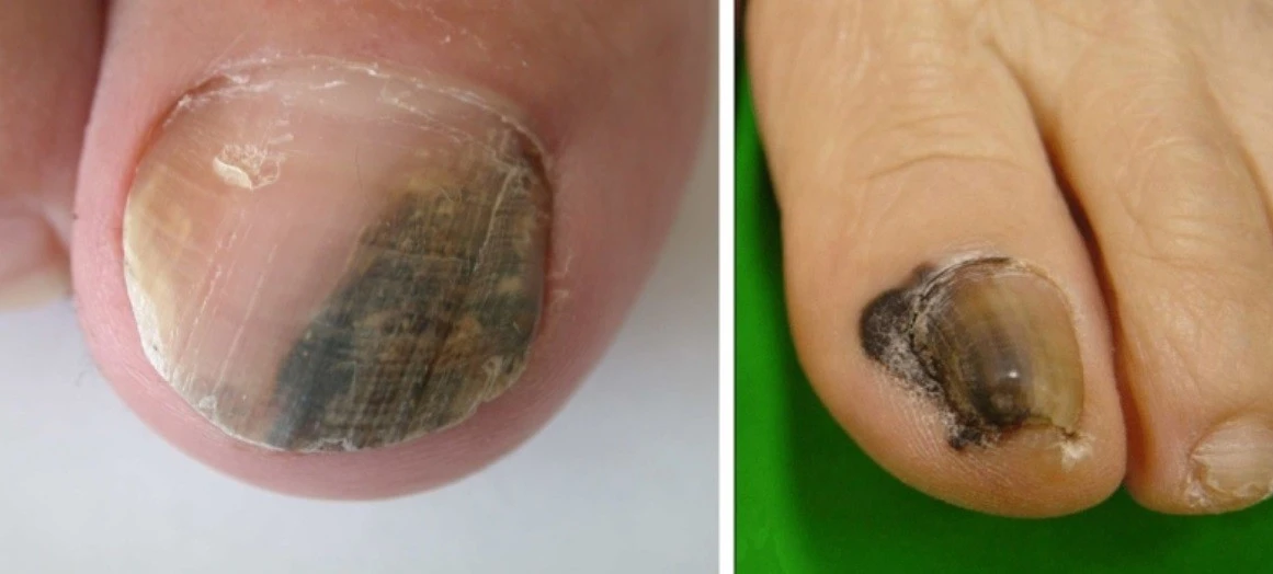 Vệt đen trên móng tay suốt 6 năm, người đàn ông phát hiện mắc ung thư nguy hiểm