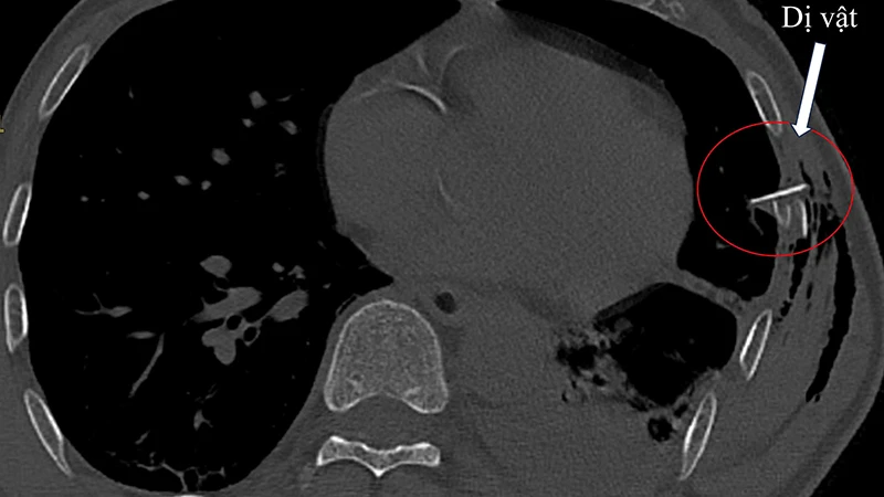 Hình ảnh chụp cắt lớp ngực của bệnh nhân V.Đ.Q. tràn khí, tràn máu màng phổi với một mảnh xương sườn đâm vào nhu mô phổi. 