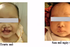 Một số hình ảnh người bệnh được phẫu thuật tại Bệnh viện Sản Nhi Nghệ An. (Ảnh: Bệnh viện cung cấp)
