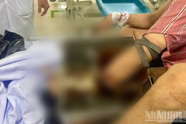 Nạn nhân bị tai nạn lao động nghiêm trọng do bất cẩn khi sử dụng máy xay thịt.