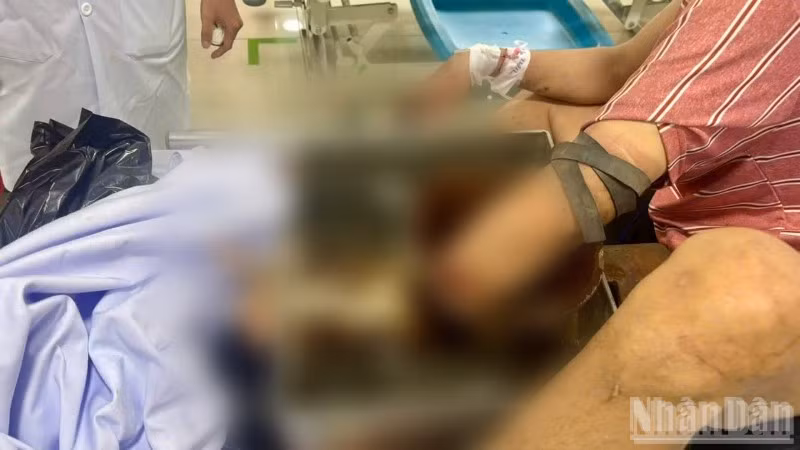 Nạn nhân bị tai nạn lao động nghiêm trọng do bất cẩn khi sử dụng máy xay thịt.