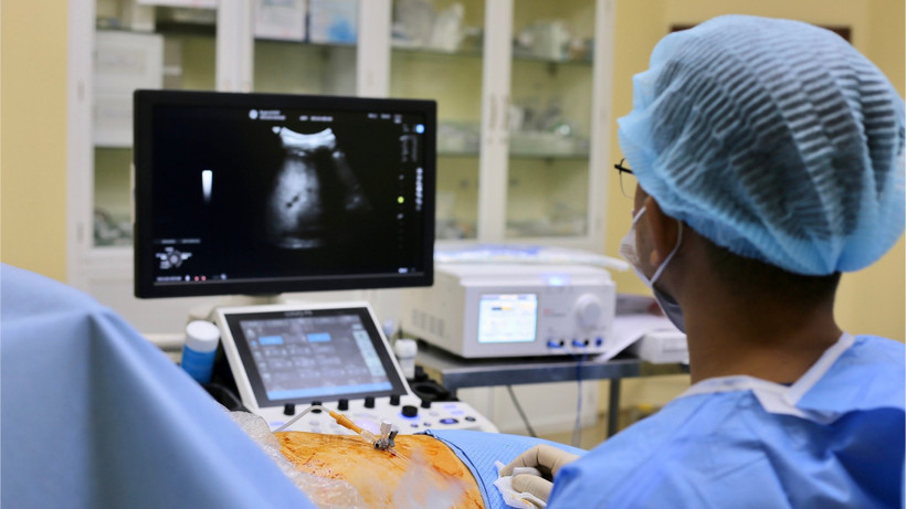 Ê-kíp đốt u gan bằng sóng cao tần (RFA).