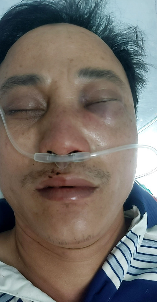Thầy giáo Nguyễn Đình Thiều, Hiệu phó Trường THPT Hàm Tân bị đánh hôn mê và đang được cấp cứu tại Bệnh viện 115, Thành phố Hồ Chí Minh.