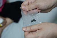 [Video] Thông tin ca bệnh: Dị vật bỏ quên-cúc áo