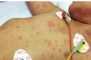 Trẻ em bị mắc bệnh viêm não mô cầu. (Ảnh minh họa)