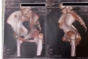 Hình ảnh 3D từ chụp cắt lớp vi tính vùng khớp háng của bệnh nhân với hình ảnh canxi hóa mô mềm quanh khớp. (Ảnh: Bệnh viện cung cấp)