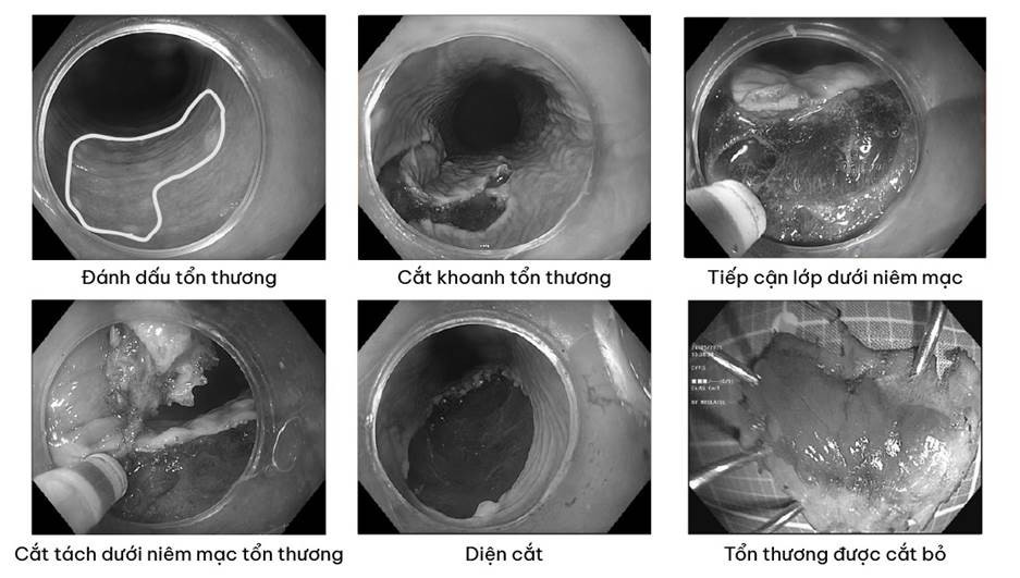 Tổn thương được loại bỏ bằng kỹ thuật xâm lấn tối thiểu - cắt tách dưới niêm mạc (ESD). Tổn thương được loại bỏ bằng kỹ thuật xâm lấn tối thiểu - cắt tách dưới niêm mạc (ESD).