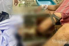 Nạn nhân bị tai nạn lao động nghiêm trọng do bất cẩn khi sử dụng máy xay thịt.