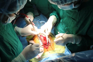 Các bác sĩ tiến hành mổ và tạo hình van động mạch chủ, thay đoạn mạch nhân tạo cho cháu A.