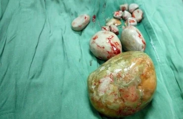 Sỏi bàng quang được lấy ra khỏi cơ thể cụ bà. 