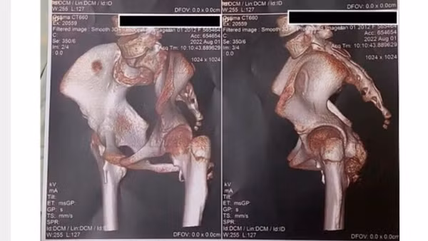 Hình ảnh 3D từ chụp cắt lớp vi tính vùng khớp háng của bệnh nhân với hình ảnh canxi hóa mô mềm quanh khớp. (Ảnh: Bệnh viện cung cấp)