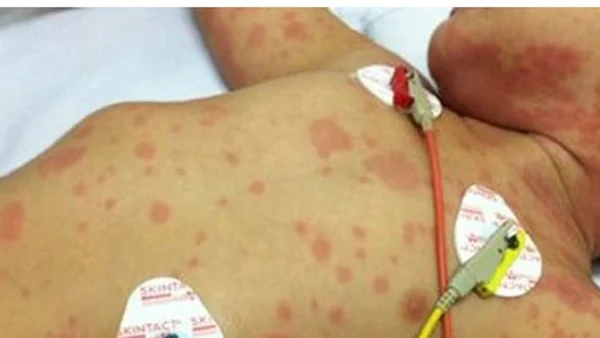 Trẻ em bị mắc bệnh viêm não mô cầu. (Ảnh minh họa)