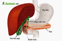 Chủ quan với sỏi túi mật, người phụ nữ bị tắc ruột
