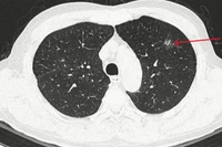 Thùy trên phổi trái có đám tổn thương kính mờ, bờ tua gai kích thước 10x13mm.