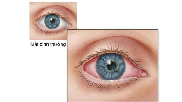 Viêm kết mạc là một trong những biểu hiện của người bệnh dương tính với Covid-19.