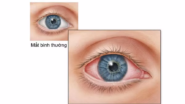 Viêm kết mạc là một trong những biểu hiện của người bệnh dương tính với Covid-19.