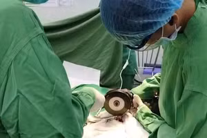 Các bác sĩ dùng cưa phẫu thuật cho bệnh nhân.