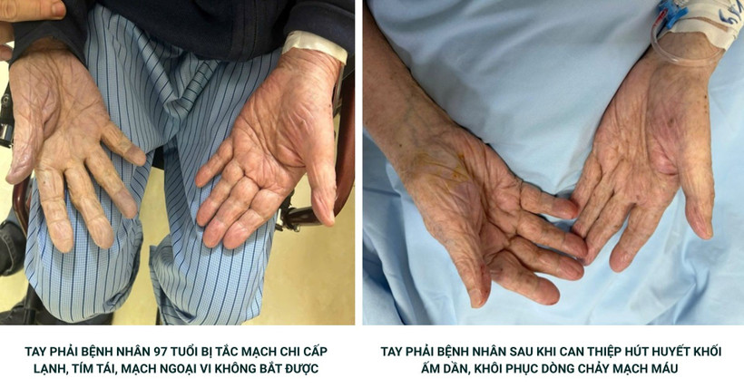 Hút nhiều cục máu đông giúp bệnh nhân 97 tuổi tránh nguy cơ hoại tử