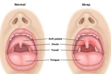 Bệnh bạch hầu gây ra những biến chứng nguy hiểm nào?