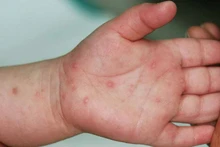 Bệnh tay chân miệng có xu hướng gia tăng