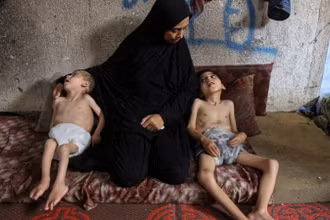 Trẻ em bị suy dinh dưỡng tại Dải Gaza. (Ảnh: THX/TTXVN)