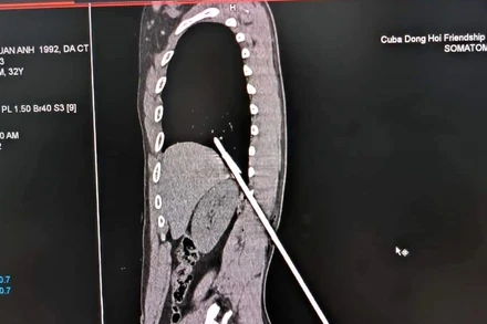 Mũi tên thép đâm vào người gây nhiều thương tổn cho bệnh nhân. (Ảnh: ĐC)