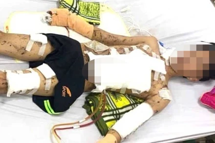 Học sinh 16 tuổi ở Quảng Bình bị thương nặng do tự chế pháo. (Ảnh: TH)