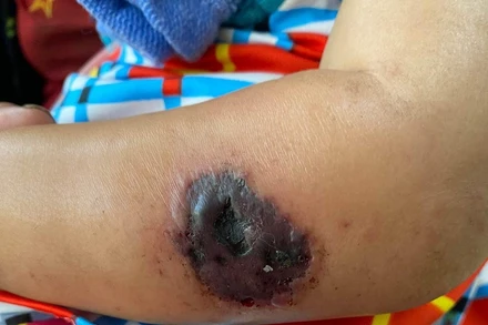 Biểu hiện bệnh than trên cơ thể của bệnh nhân thứ 14 vừa được phát hiện tại tỉnh Điện Biên.