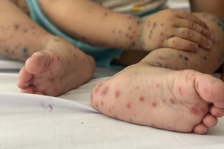 Các trường hợp bệnh nhân bệnh tay chân miệng mới đây đều là các em dưới 5 tuổi.