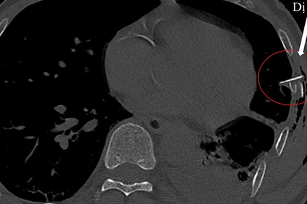 Hình ảnh chụp cắt lớp ngực của bệnh nhân V.Đ.Q. tràn khí, tràn máu màng phổi với một mảnh xương sườn đâm vào nhu mô phổi. 