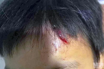 Vùng trán cháu L.M.T. bị rách da vào hôm người anh ruột phát hiện vụ việc. 