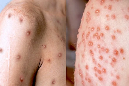 Một số biểu hiện thương tổn da là những mụn mủ, bóng mủ đa kích thước… của bệnh Đậu mùa khỉ (ảnh Báo Phụ nữ).