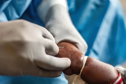 Nhân viên y tế điều trị cho em nhỏ mắc đậu mùa khỉ tại Nyiragongo, Cộng hòa Dân chủ Congo ngày 15/8/2024. (Ảnh: THX/TTXVN)