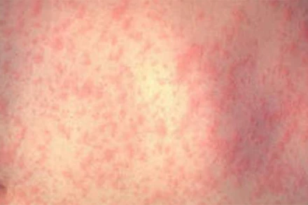 Bùng phát dịch sởi tại Mỹ, CDC ban bố cảnh báo đi lại