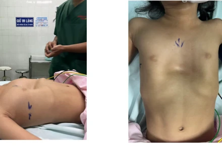 Hiện nay sức khỏe của bệnh nhi ổn, đã được ra viện; dự kiến khoảng 1,5 đến 2 năm, bé sẽ được rút thanh nâng ngực.