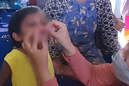 Cháu bé T.N.T (sinh năm 2020) bị nhiều vết bầm trên cơ thể, nghi ngờ bị cha nuôi đánh đập, hành hạ.