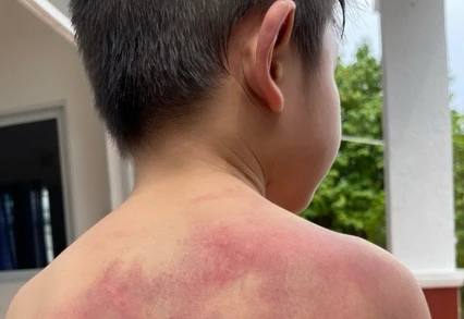 Cháu Đ bị nhiều vết bầm tím trên cơ thể do cha đánh.