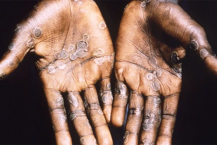 Lòng bàn tay của người mắc đậu mùa khỉ. (Ảnh: Reuters)