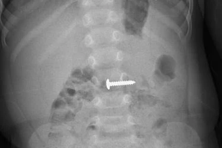 Hình ảnh chụp X-quang của bệnh nhi H. 