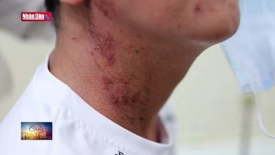 Nhiều bệnh nhân bị bội nhiễm da do độc tố của kiến ba khoang