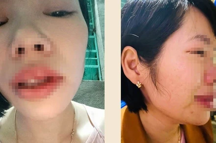 Cô giáo Vũ Thị Kim Q bị phụ huynh học sinh đến tận nhà riêng hành hung.