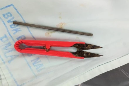 Thanh sắt và chiếc kéo cắt chỉ được lấy ra khỏi dạ dày bệnh nhân.