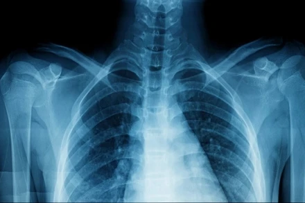 Nghiên cứu cho thấy khi ô nhiễm tăng lên, mật độ khoáng chất trong xương giảm xuống ở tất cả các vùng xương trong cơ thể. Ảnh minh họa: Getty Images