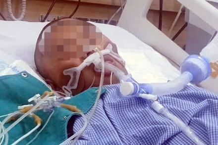 Bệnh nhân Sùng A Dương đang điều trị tại Bệnh viện Bạch Mai.